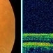 Macular Telangiectasia Type 2 &  CNV Macular Telangiectasia Type 2 &  CNV